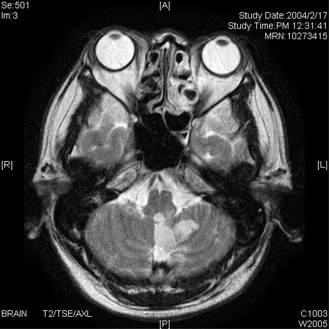 mri 目 を 開ける